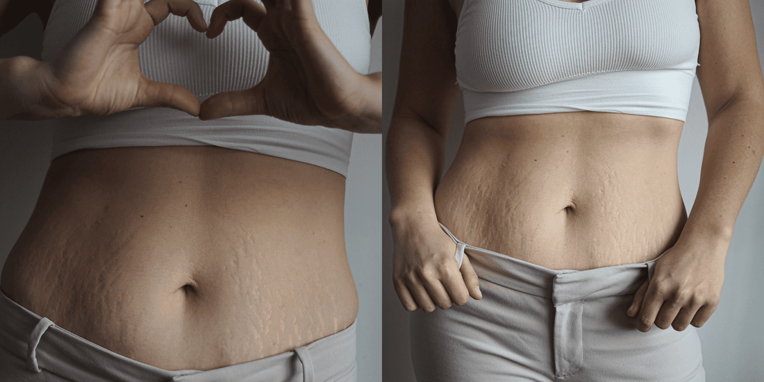 How to Get Rid of Stretchmarks Naturally