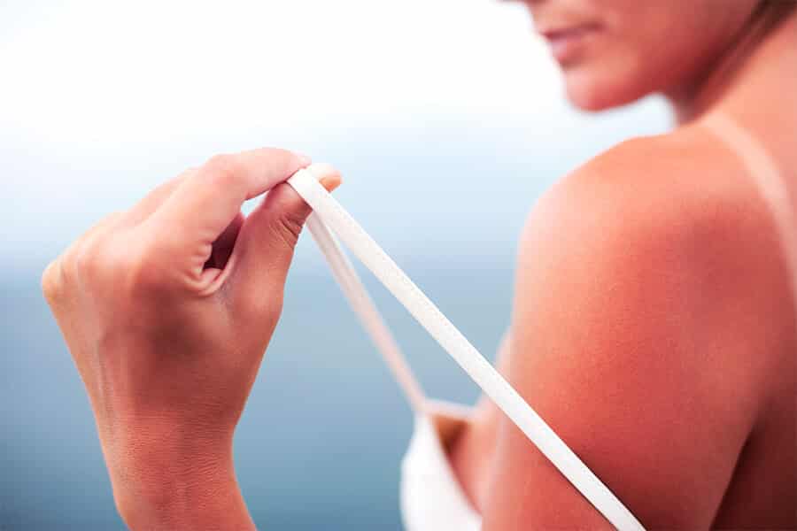 How to Treat a Sunburn … Naturally