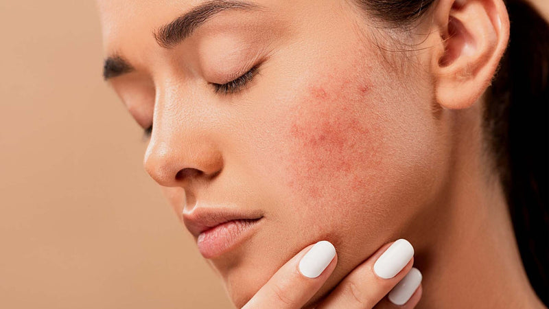 How to Treat Adult Acne: The Complete Guide