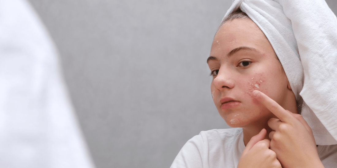 How to Treat Adult Acne: The Complete Guide