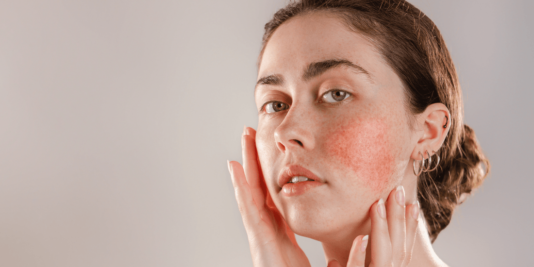 How to Reduce the Visibility of Rosacea: Natural Treatment Tips