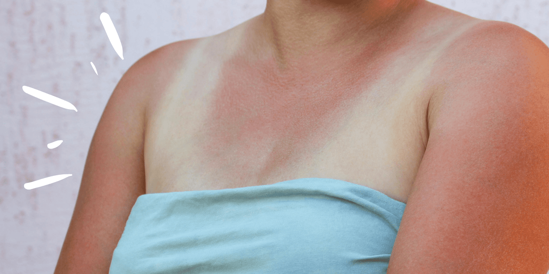 Sunburned? Now What? — Your Guide to Healing Skin with Aloe + More