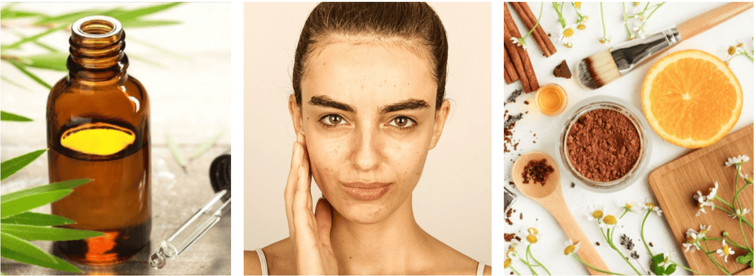Get Rid of Acne Naturally With These 4 Ingredients