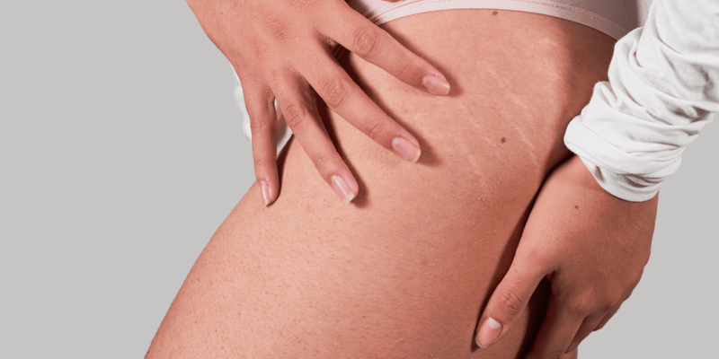 How to Diminish Stretchmarks & Discoloration in Your Skin