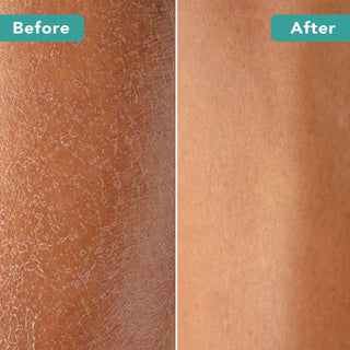 Dry Brush With Cellulite Massager - Before and After